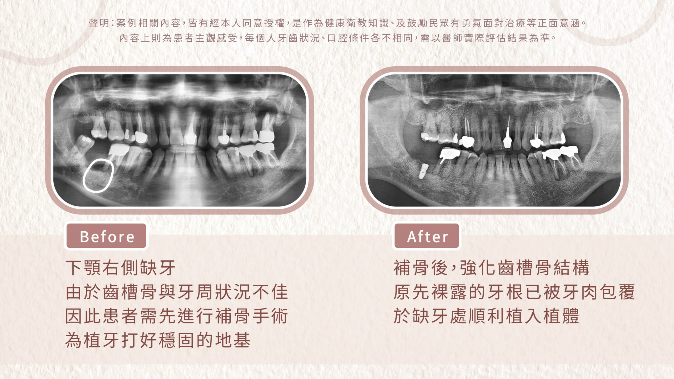 植牙前先進行補骨手術來穩固牙周地基